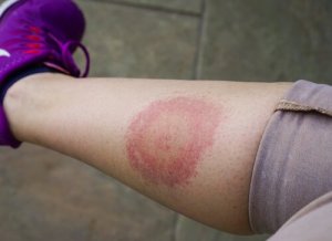 Tout ce que vous devez savoir sur la maladie de Lyme
